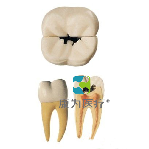 “康为医疗”磨牙蛀牙模型