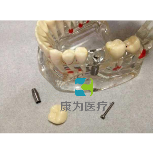 “康为医疗”综合病理水晶牙列模型(可拆)
