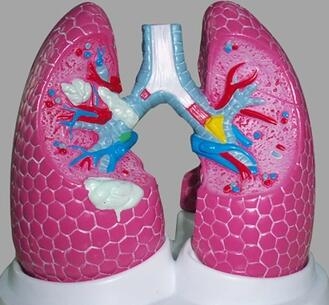 “康为医疗”吸烟者病理肺模型